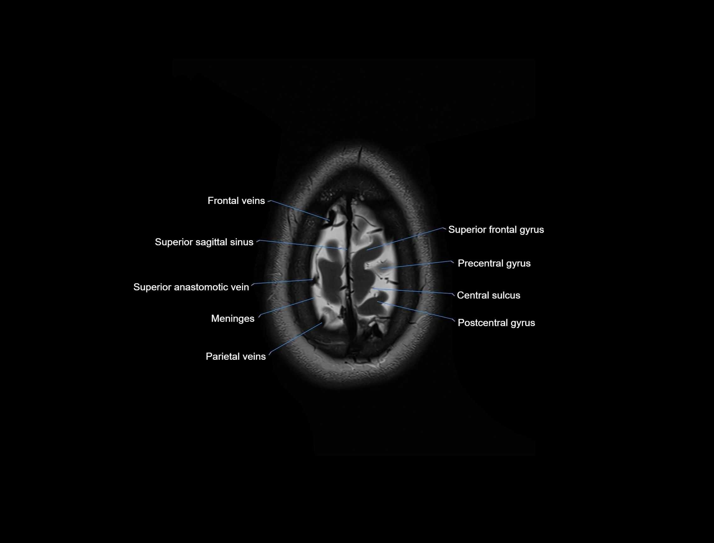 MRI Brain axial cross sectional radiology anatomy 3T image  -img-00001-00057.webp
